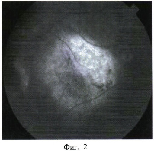 Способ лечения "влажной" формы возрастной макулярной дегенерации (патент 2541834)
