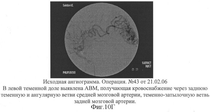 Способ эмболизации артериовенозных мальформаций головного мозга в условиях общей анестезии и управляемой гипотонии (патент 2315634)