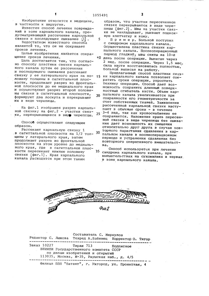 Способ пластики связки карпального канала (патент 1055491)