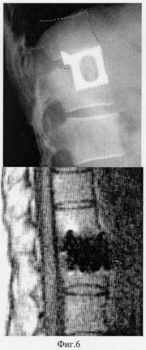 Способ ремоделирования позвоночного канала (патент 2254083)