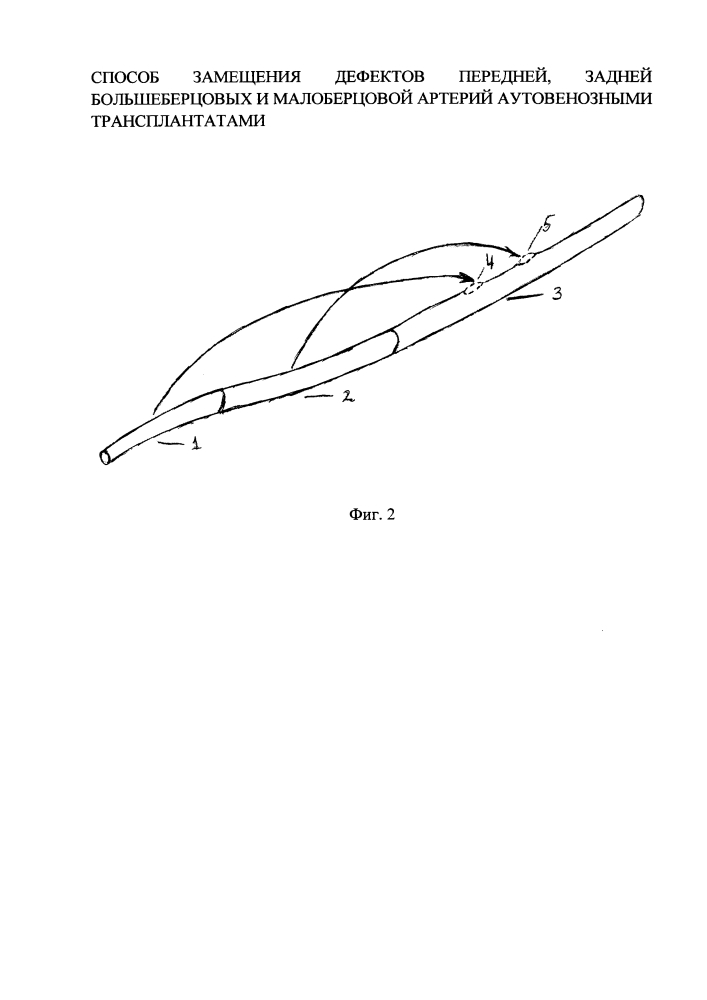 Способ замещения дефектов передней, задней большеберцовых и малоберцовой артерий аутовенозными трансплантатами (патент 2644289)