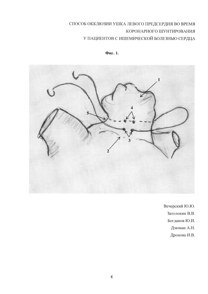 Способ окклюзии ушка левого предсердия во время коронарного шунтирования у пациентов с ишемической болезнью сердца (патент 2621954)