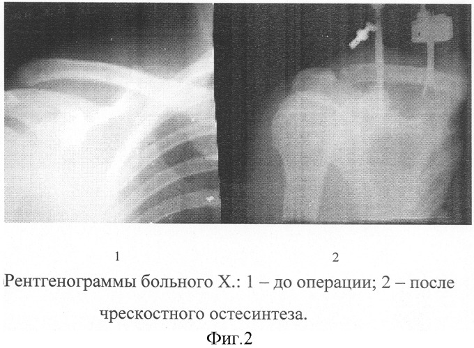 Способ чрескостного остеосинтеза переломовывихов акромиального конца ключицы (патент 2299701)