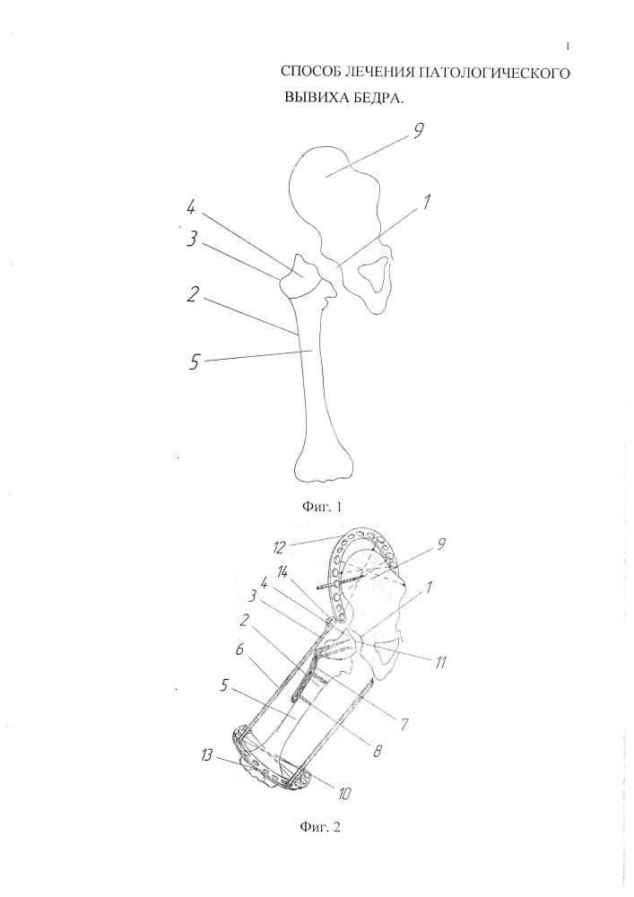 Способ лечения патологического вывиха бедра (патент 2611884)