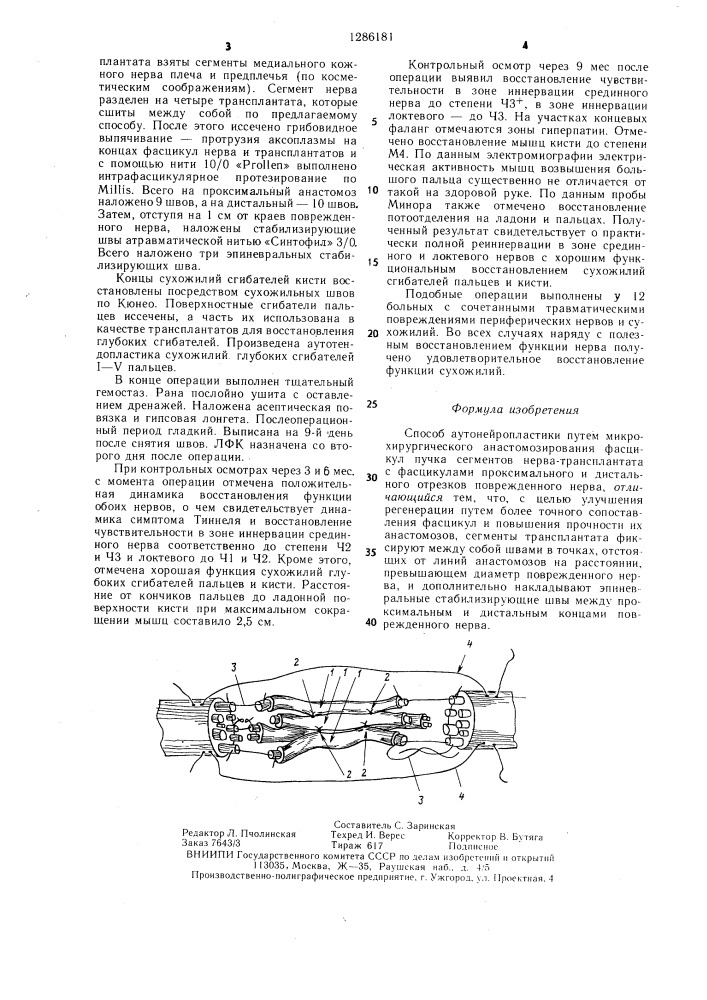 Способ аутонейропластики (патент 1286181)