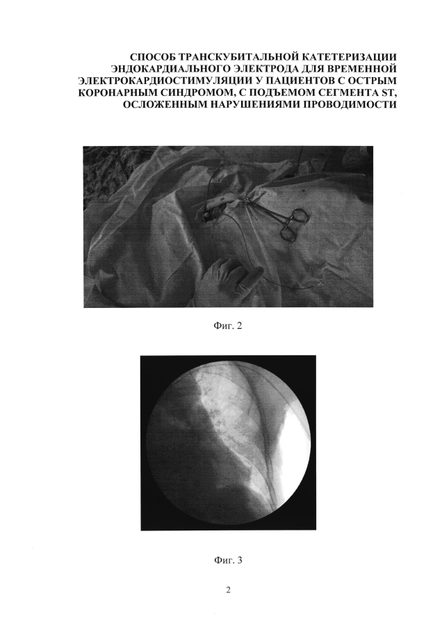 Способ катетеризации сердца для установки эндокардиального электрода для временной электрокардиостимуляции у пациентов с острым коронарным синдромом, с подъемом сегмента st, осложенным нарушениями проводимости (варианты) (патент 2594243)
