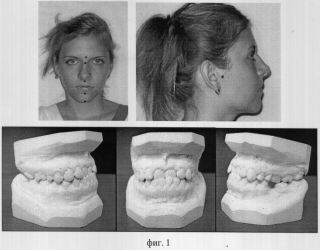 Способ оценки аномалий верхнего зубного ряда в сагиттальном направлении (варианты) (патент 2303396)