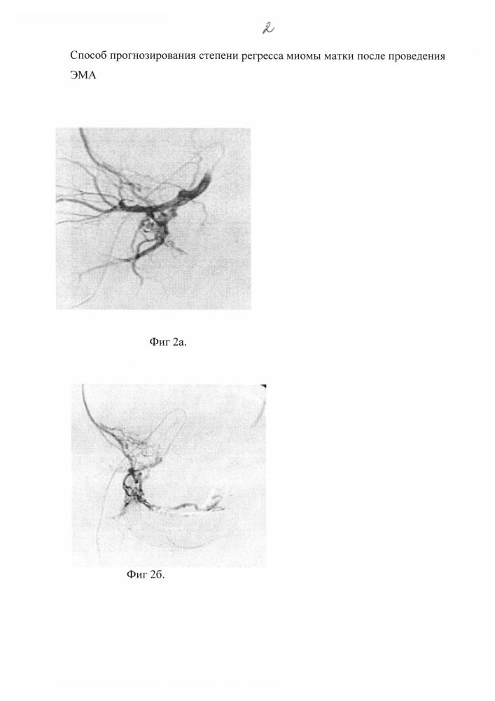 Способ прогнозирования степени регресса миомы матки (патент 2596093)