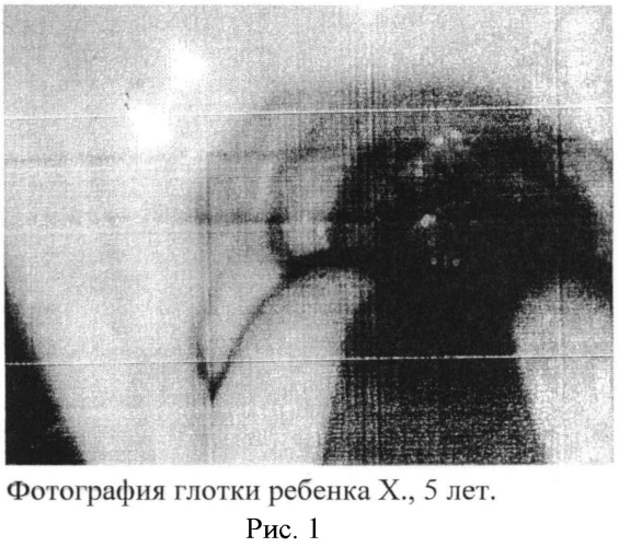 Способ определения провоспалительных и проаллергических интерлейкинов в назальном секрете у детей раннего и дошкольного возраста для диагностики этиологии рецидивирующих острых ринофарингитов и аденоидитов (патент 2569054)