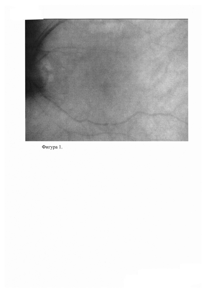 Способ определения посттравматических изменений глазного дна и уточнения тяжести поражения (патент 2624374)