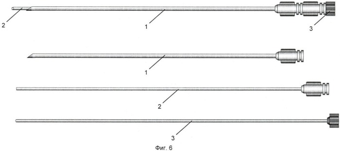 Способ эндоскопической коррекции пузырно-мочеточникового рефлюкса (патент 2457792)