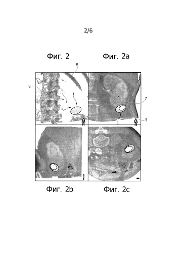 Планирование абляционного лечения и устройство (патент 2581714)