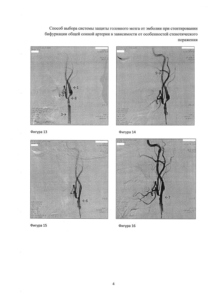Способ выбора системы защиты головного мозга от эмболии при стентировании бифуркации общей сонной артерии в зависимости от особенностей стенотического поражения (патент 2609206)