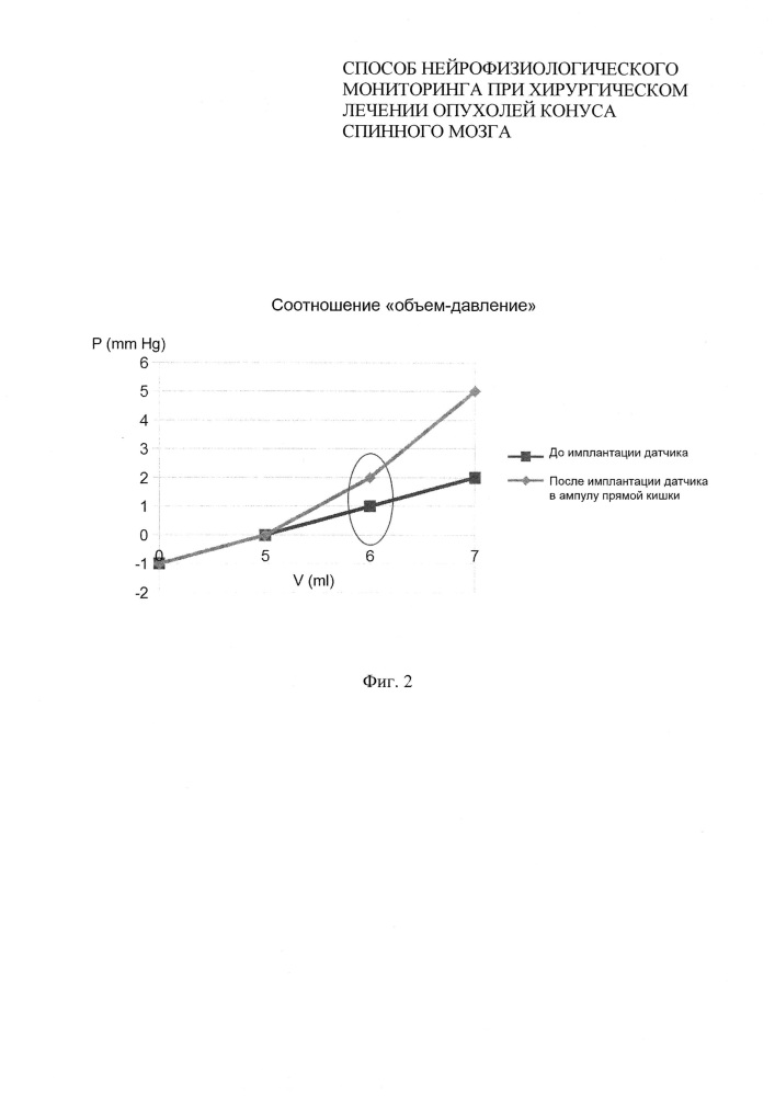 Способ нейрофизиологического мониторинга при хирургическом лечении липом конуса спинного мозга (патент 2621411)