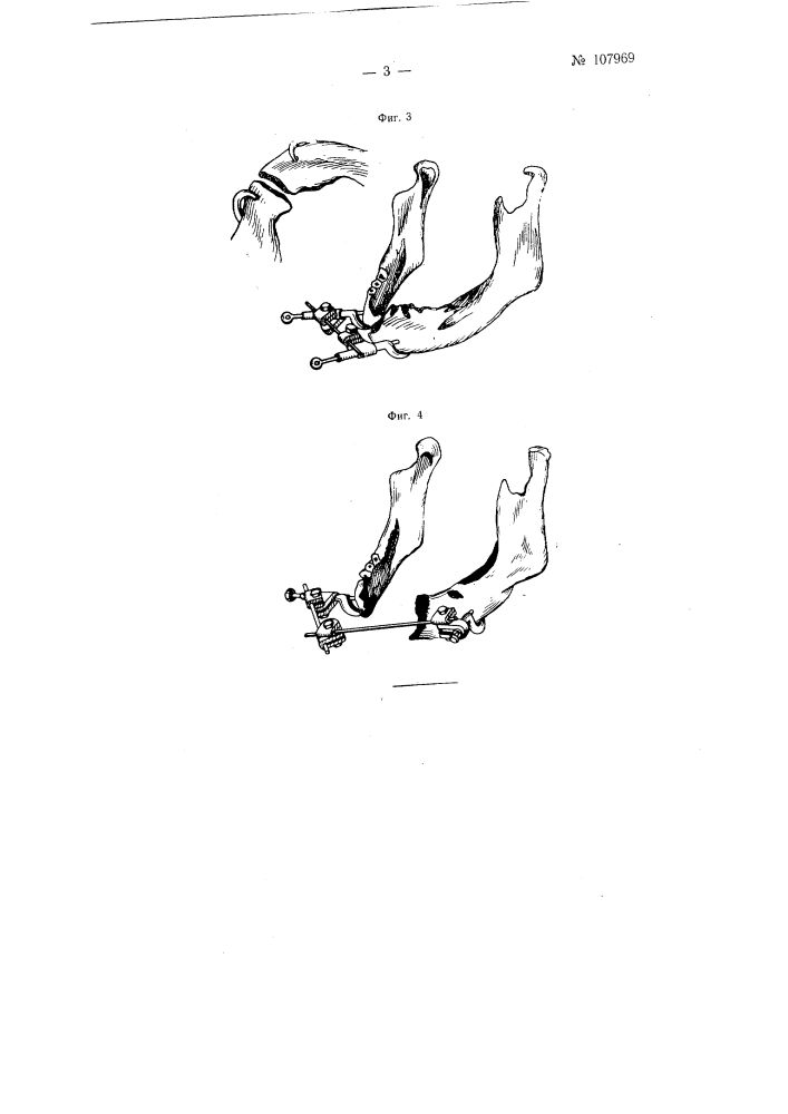 Аппарат для вне ротовой репозиции и фиксации отломков нижней челюсти при операциях на ней (патент 107969)