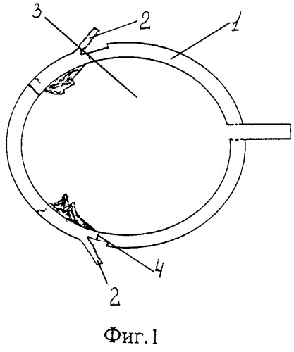 Способ хирургической коррекции тотальной аниридии, сочетанной с афакией в однокамерном глазу (патент 2247546)