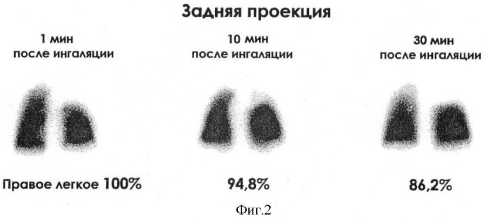 Способ оценки нарушений вентиляции и перфузии в раннем послеоперационном периоде при радикальных вмешательствах на легких у онкологических больных (патент 2391910)