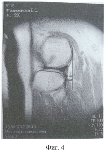 Способ магнитно-резонансной томографии для определения передней нестабильности коленного сустава (патент 2511400)