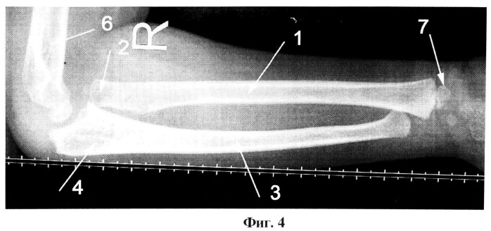 Способ артродеза проксимального лучелоктевого сочленения у детей с вялыми параличами верхней конечности (патент 2492833)