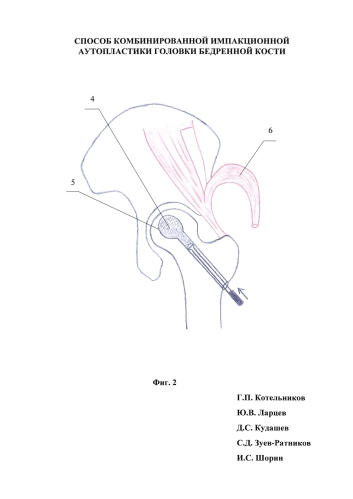Способ комбинированной импакционной аутопластики головки бедренной кости (патент 2583577)
