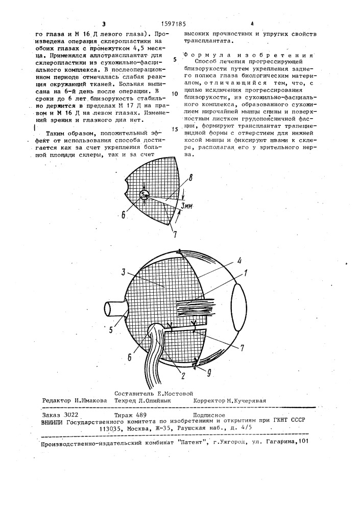 Способ лечения прогрессирующей близорукости (патент 1597185)