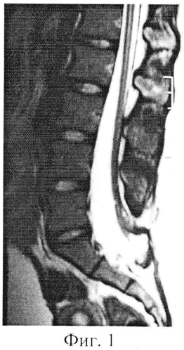 Способ хирургического лечения синдрома фиксированного спинного мозга при вторичной фиксации спинного мозга (патент 2574715)