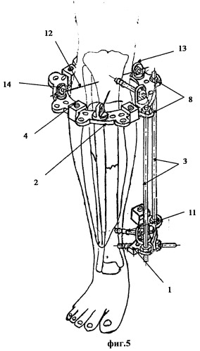 Аппарат для лечения больных с сочетанными повреждениями голени и стопы (патент 2476181)