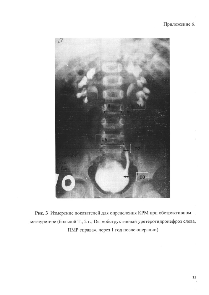 Способ оценки результатов хирургического лечения обструктивного мегауретера у детей раннего возраста (патент 2608063)