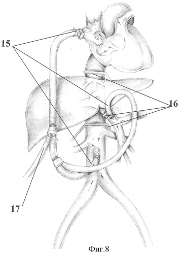 Способ временного сосудистого шунтирования при трансплантации и аутотрансплантации печени (патент 2317010)