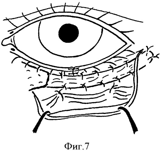 Способ устранения сенильного выворота нижнего века (патент 2380067)