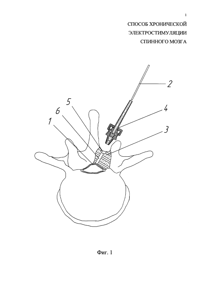 Способ хронической электростимуляции спинного мозга (патент 2611901)