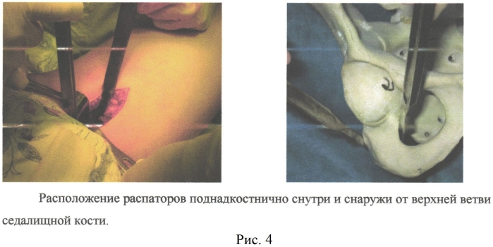 Способ выполнения периацетабулярной тройной остеотомии таза у подростков (патент 2556788)
