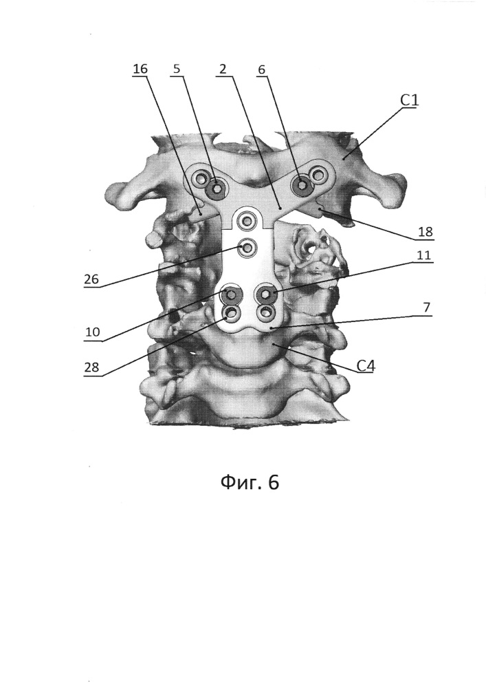 Устройство для передней стабилизации с1-с4 позвонков (патент 2652740)