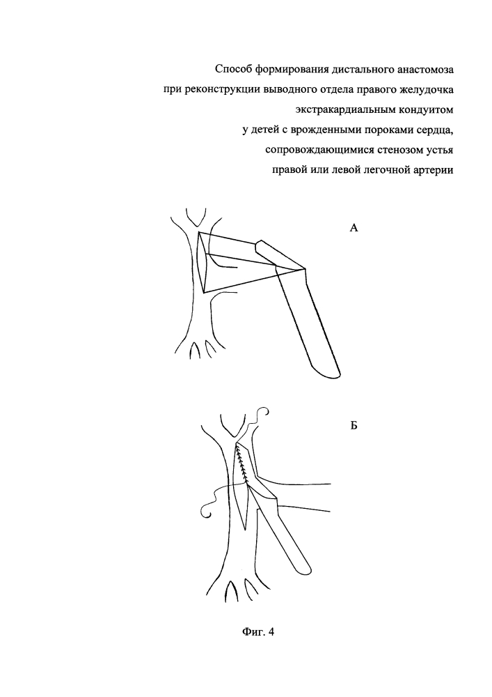 Способ формирования дистального анастомоза при реконструкции выводного отдела правого желудочка экстракардиальным кондуитом у детей с врожденными пороками сердца, сопровождающимися стенозом устья правой или левой легочной артерии (патент 2647226)