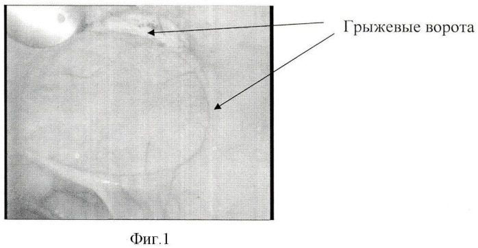 Способ комбинированной лапароскопической герниопластики (патент 2435528)