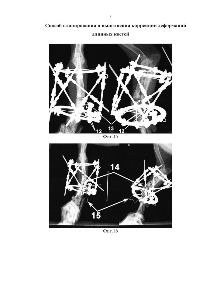 Способ планирования и выполнения коррекции деформаций длинных костей (патент 2641840)