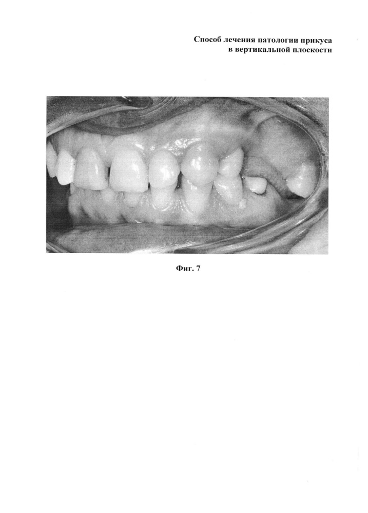 Способ лечения патологии прикуса в вертикальной плоскости (патент 2617181)