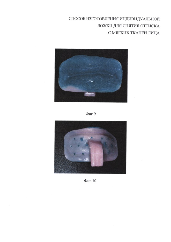 Способ изготовления индивидуальной ложки для снятия оттисков с мягких тканей лица (патент 2648848)