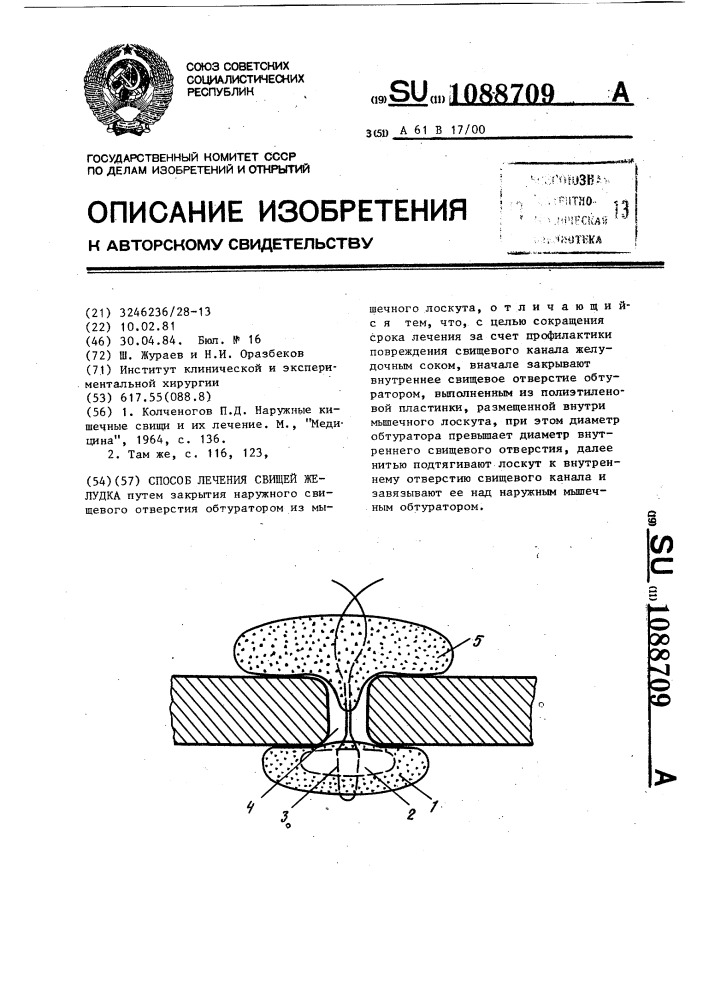 Способ лечения свищей желудка (патент 1088709)