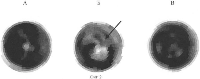 Способ диагностики гемодинамически значимого атеросклероза коронарных артерий (патент 2406443)