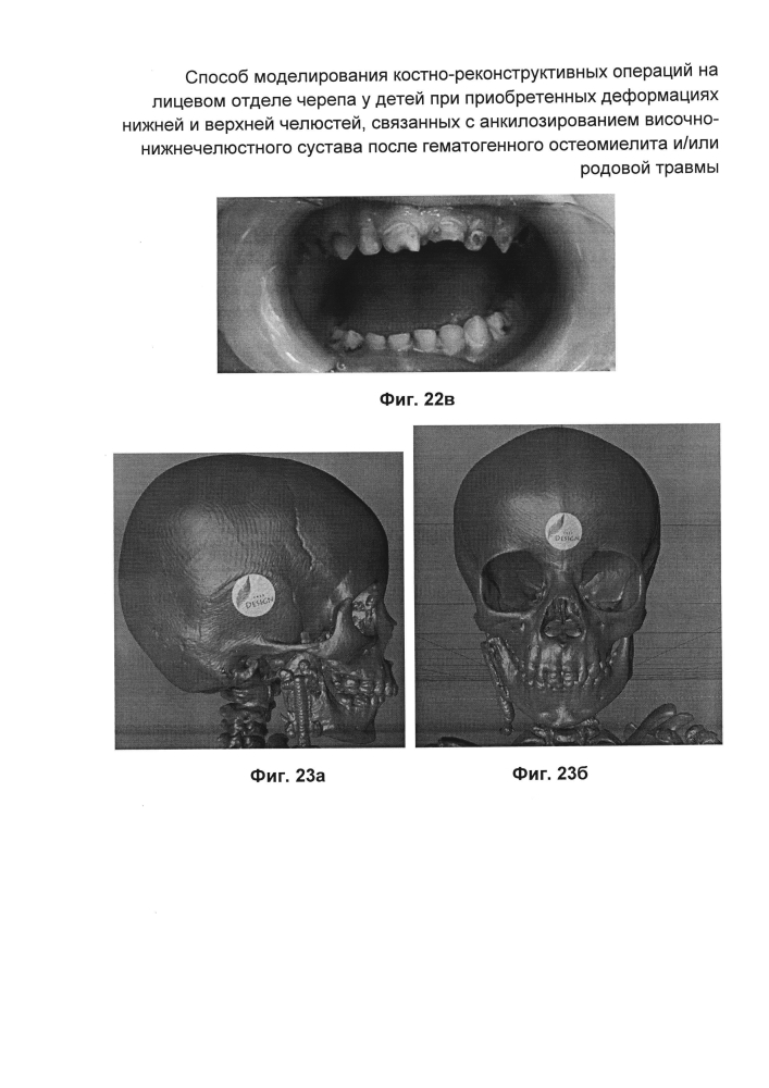 Способ моделирования костно-реконструктивных операций на лицевом отделе черепа у детей при приобретенных деформациях нижней и верхней челюстей, связанных с анкилозированием височно-нижнечелюстного сустава после гематогенного остеомиелита и/или родовой травмы (патент 2604774)