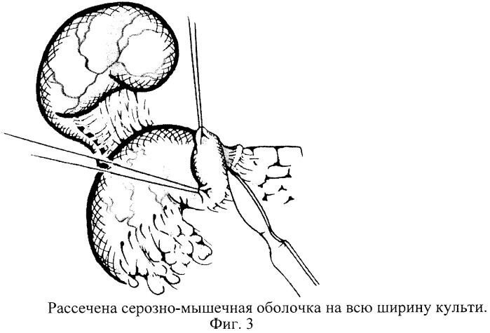 Способ редуоденизации при болезни оперированного желудка (патент 2255672)