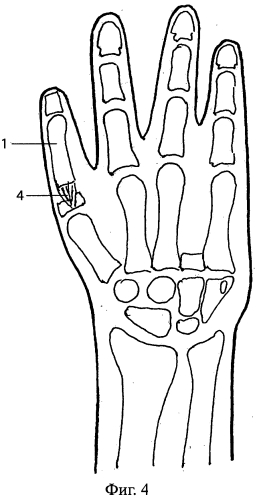 Способ восстановления пальца кисти (патент 2550301)