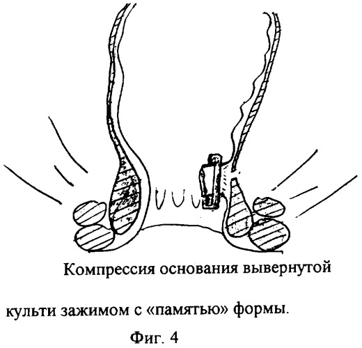 Способ хирургической коррекции сложных параректальных свищей (патент 2290881)