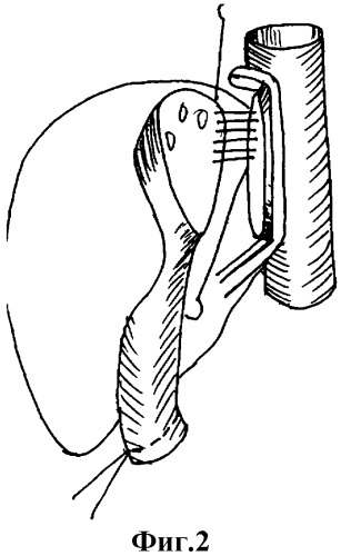 Способ восстановления венозного кровотока в трансплантате при ортотопической пересадке печени (патент 2312610)