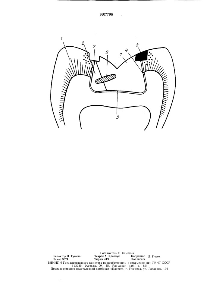 Способ протезирования дефектов твердых тканей жевательных зубов вкладками (патент 1607796)