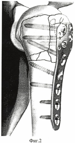 Способ оперативного лечения трехфрагментарных переломов проксимального отдела плечевой кости (патент 2447853)