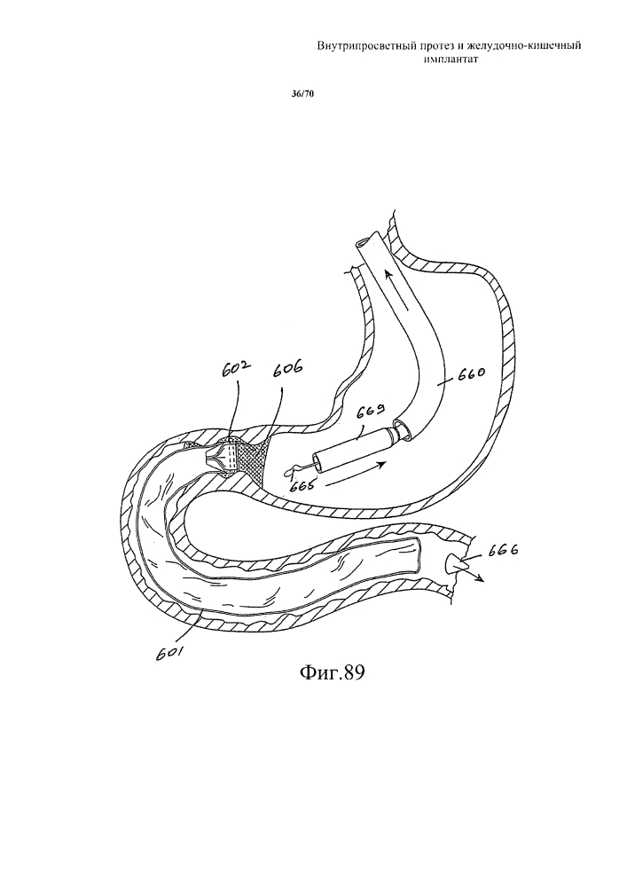 Внутрипросветный протез и желудочно-кишечный имплантат (патент 2626885)