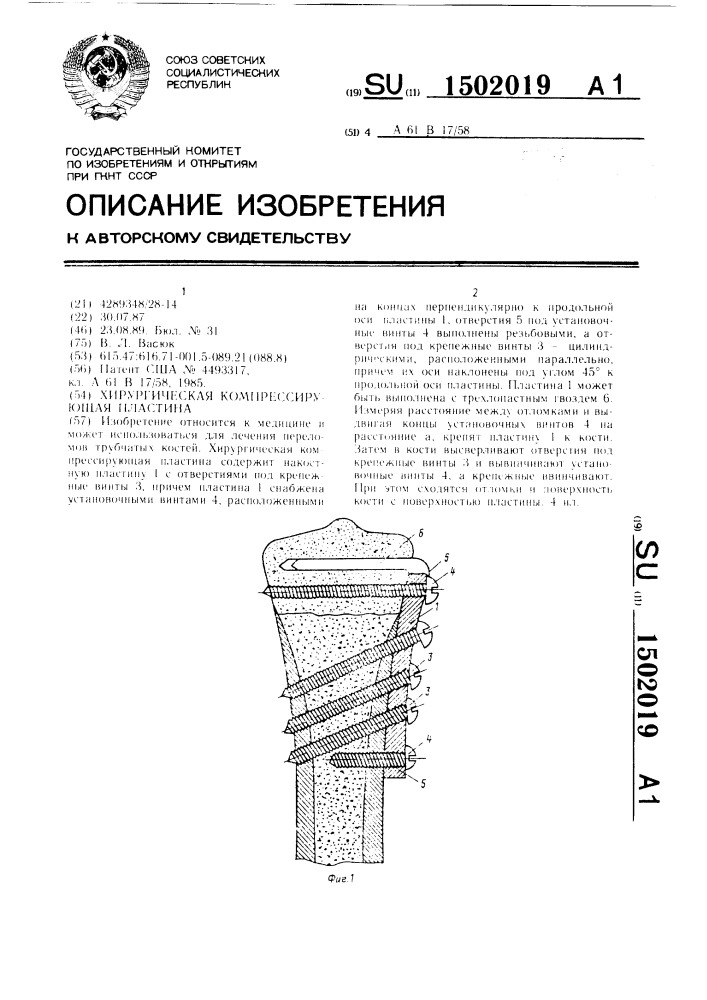 Хирургическая компрессирующая пластина (патент 1502019)