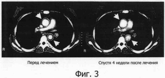 Профилактическое средство против васкулита (патент 2379054)